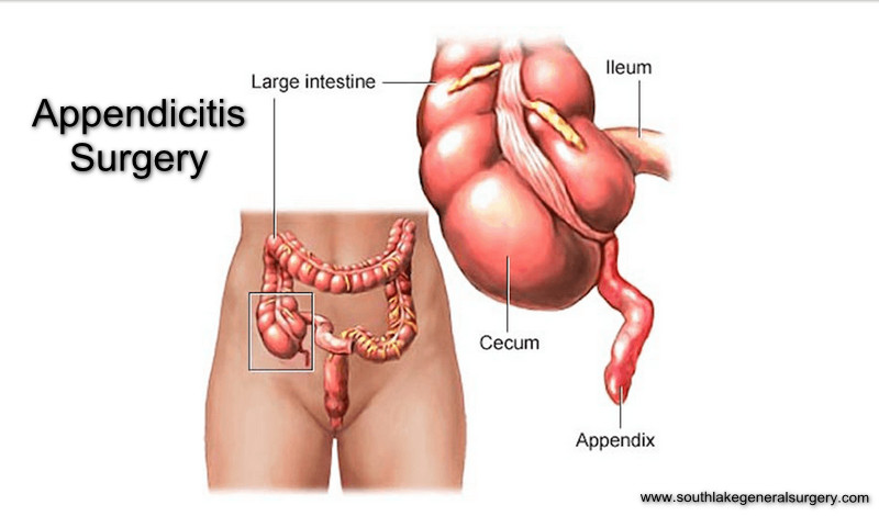 Gall Bladder Stone Surgery Appendix Surgery in Goregaon