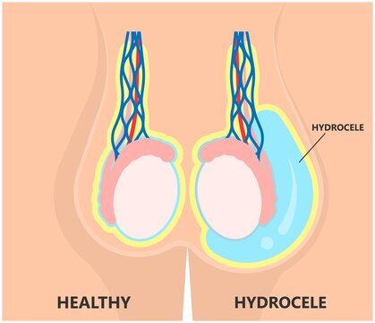 Hernia Hydrocoele Surgery in Goregaon